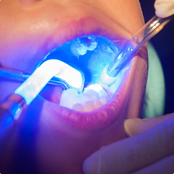 Special lights being used to harden dental sealants in place