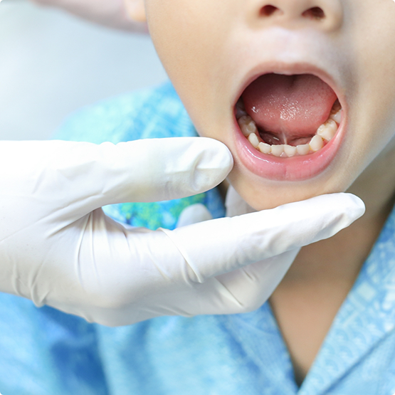 Gloved hand and child opening mouth to show tongue-tie