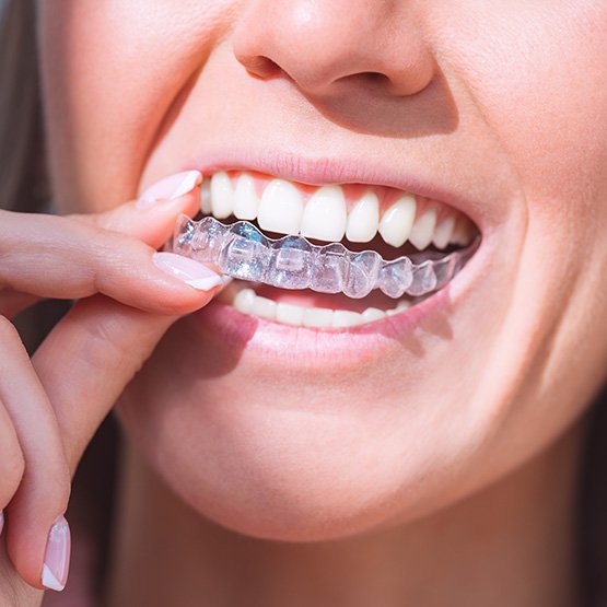 Woman putting clear aligner over top teeth