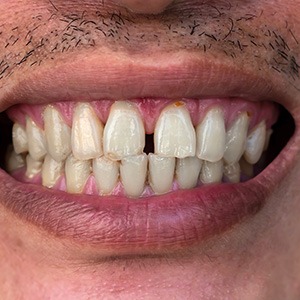 Closeup of man’s teeth with diastema