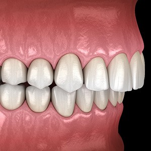 Illustrated profile view of overbite with black background