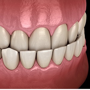 Illustrated profile view of underbite with black background