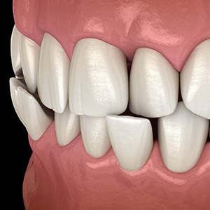 Illustrated profile view of crossbite closeup with black background