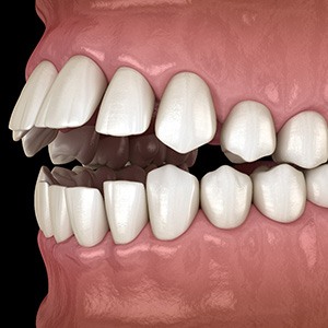 Illustrated profile view of open bite with black background