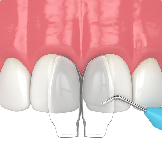 Illustration of cosmetic bonding performed on upper teeth