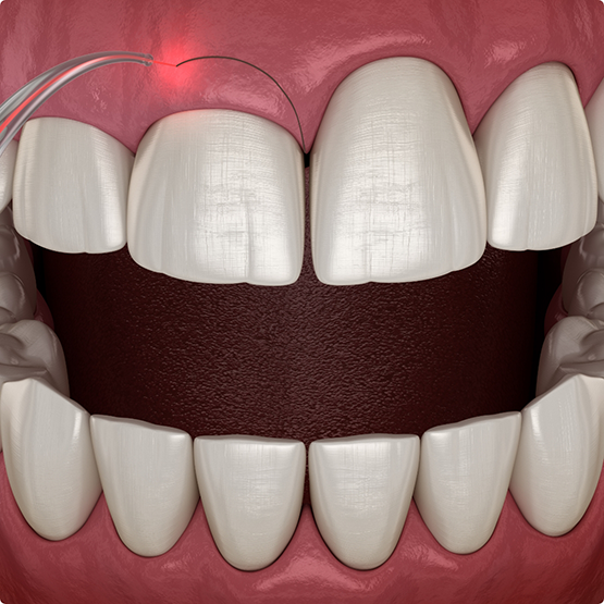 Illustration of gum recontouring with soft tissue laser