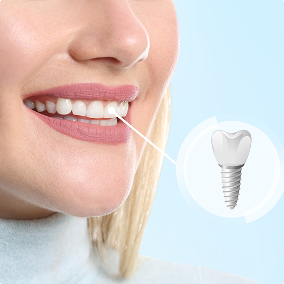 Woman smiling with dental implant pointed out