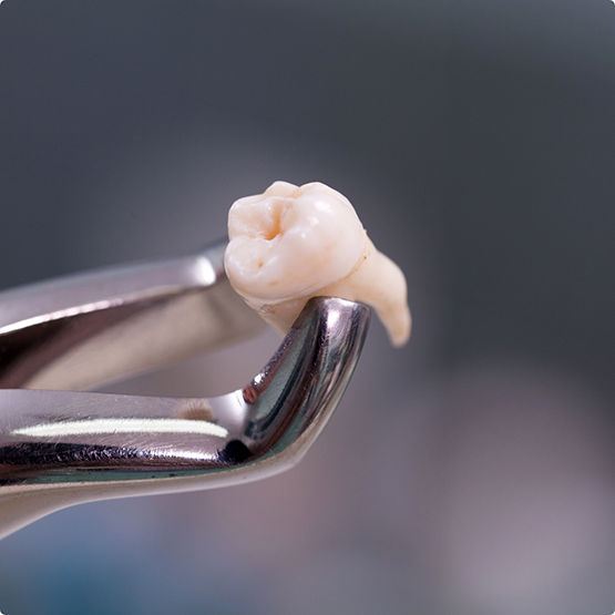 Close up of forceps holding tooth after a tooth extraction in Phoenix