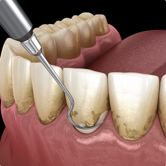 Illustration of scaling and root planing performed on lower teeth