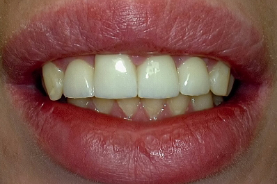 Teeth restored after dental treatment