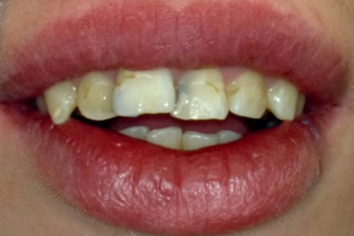 Teeth damaged before dental treatment