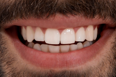 Close up of smile with repaired tooth