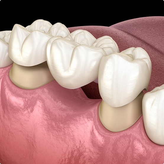 Illustration of a dental bridge being attached to prepared teeth