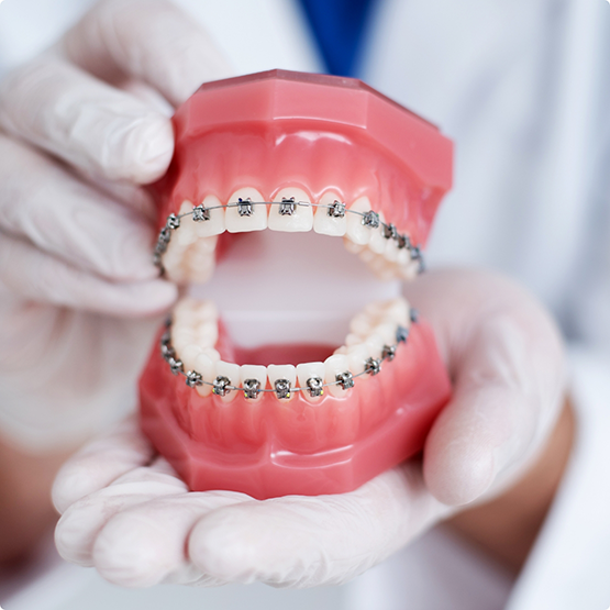 Holding model of teeth with traditional braces