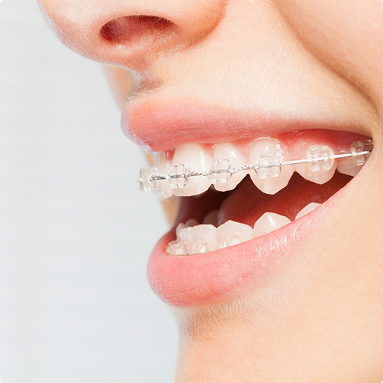 Close up of teeth with braces with clear brackets