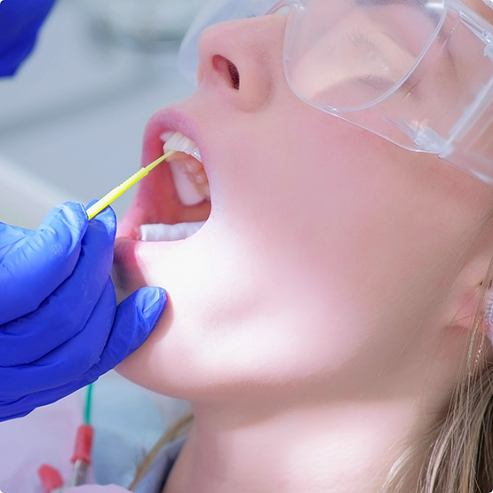 Applying fluoride to patient's upper teeth