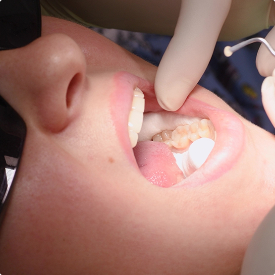 Patient opening mouth for restorative dentistry in Phoenix