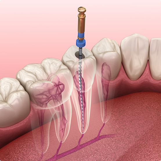 Illustration of root canal treatment in Phoenix