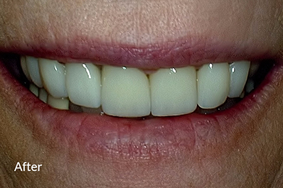 Close up of brightened, corrected teeth