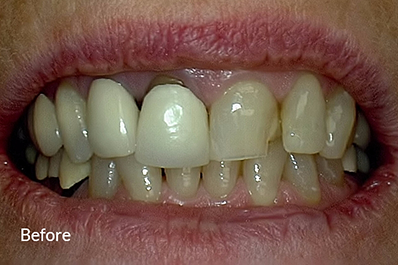 Close up of discolored, misshapen teeth