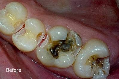 Close up of badly decayed teeth