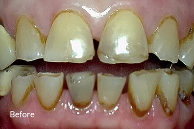 Close up of damaged teeth