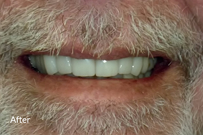 Close up of whitened and restored teeth