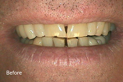 Close up of yellowed and misshapen teeth