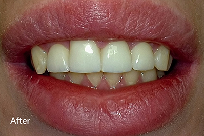 Close up of teeth after removal of discolored spots