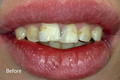 Close up of teeth with discolored spots