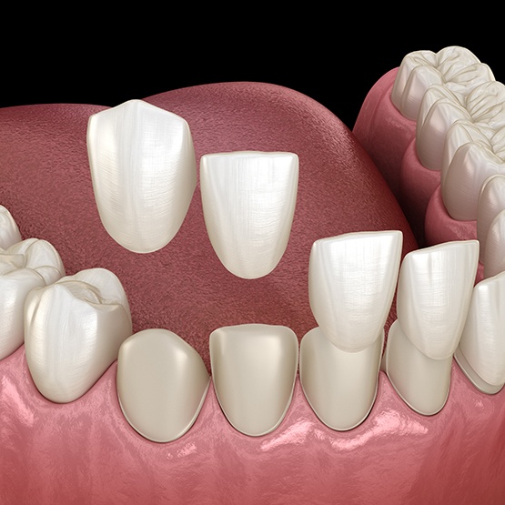 Digital view of dental veneers