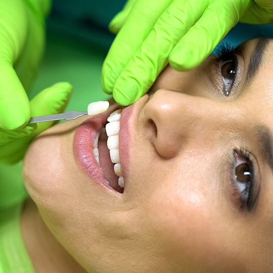 Dentist using shade guide to prepare for veneers