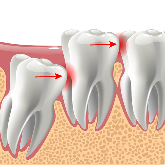 Illustration of impacted wisdom tooth pushing on other teeth